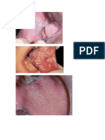 Oral Mucosal Lesions Pics