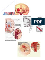 Gambar Stroke Hemoragik