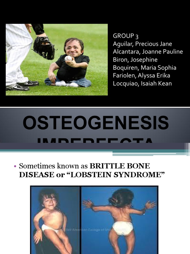 osteogenesis-imperfecta-pdf-health-sciences-clinical-medicine