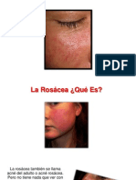 Que Es Rosacea - Rosacea Imagenes, Rosacea Tiene Cura, Como Eliminar La Rosacea