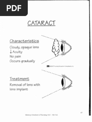 Cataract