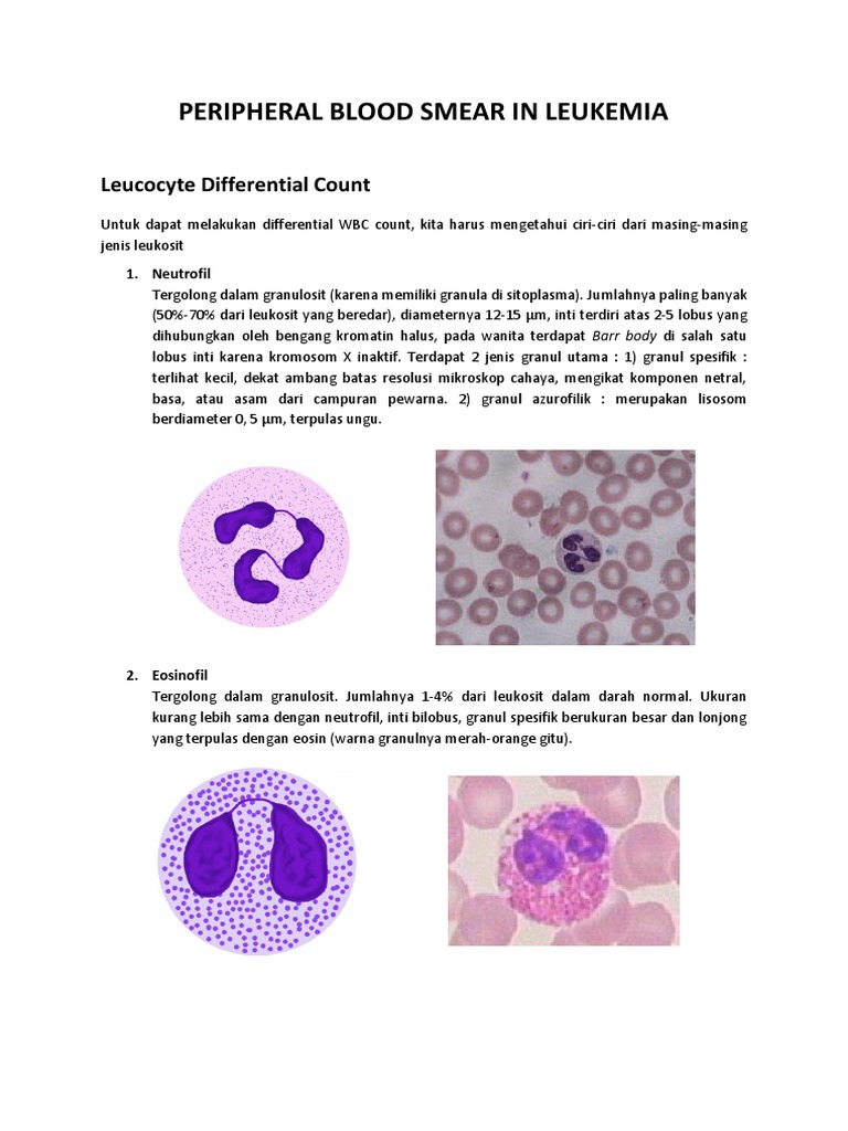 Peripheral Blood Smear In Leukemia Leucocyte Differential Count