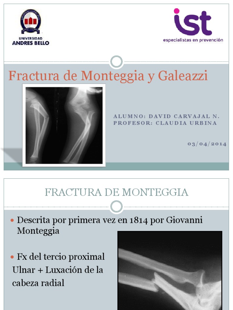 Fractura de Monteggia y Galeazzi | Traumatologia | Cirugía Ortopédica