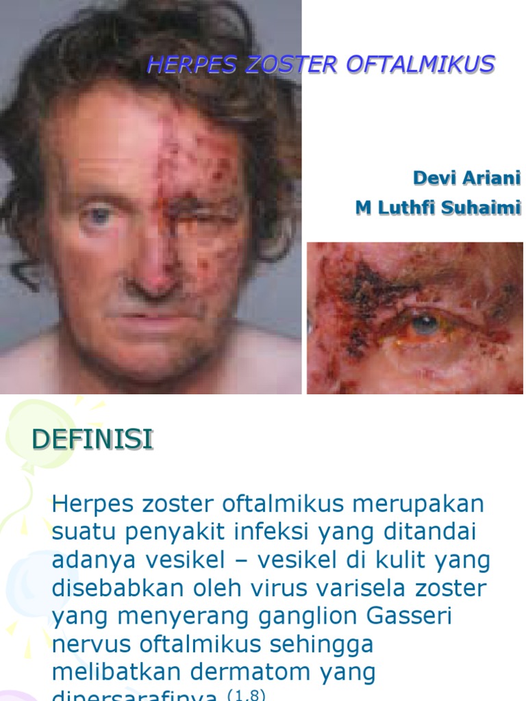 Herpes Zoster Oftalmikus