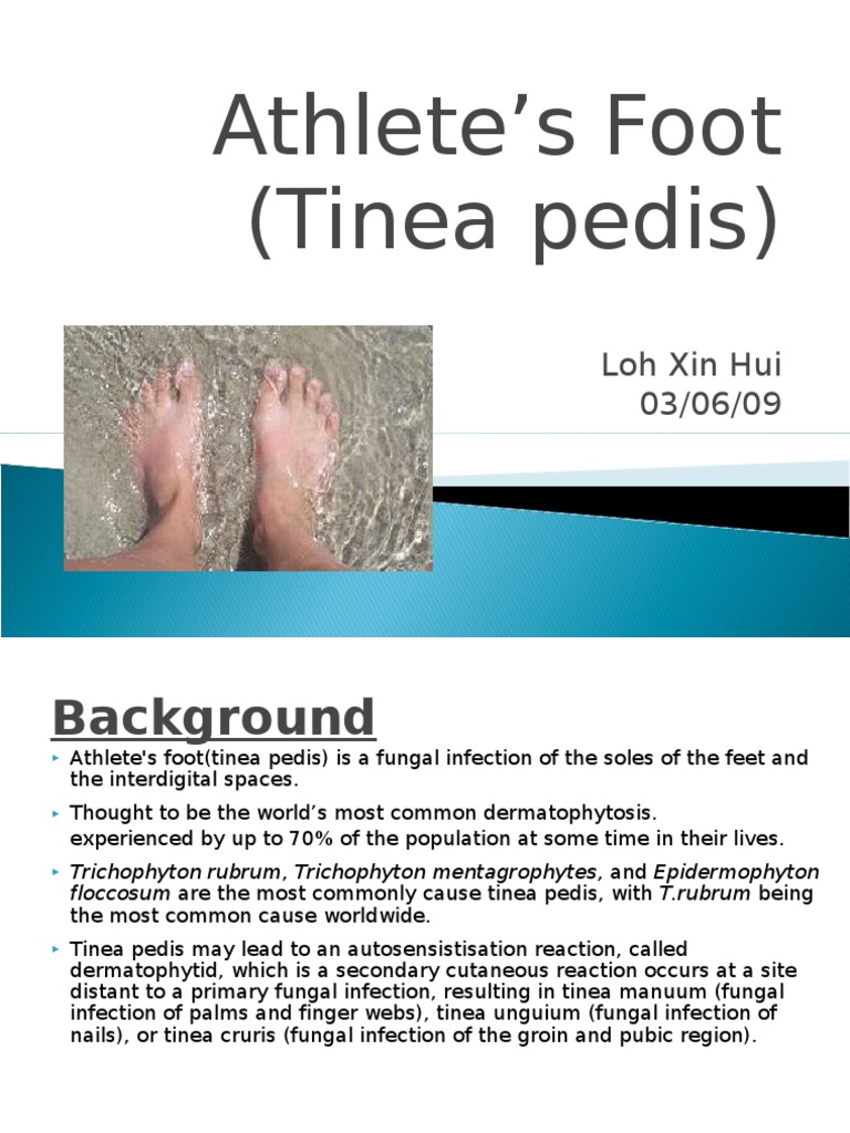 Athlete's Foot (Tinea Pedis) Immunology Clinical Medicine