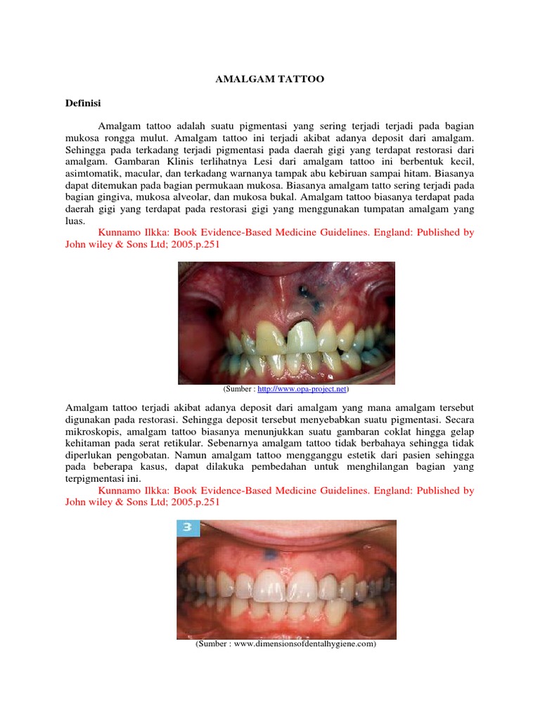 Mandiri Sken 2 (Amalgam Tattoo) PDF