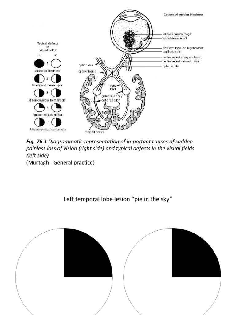 Visual Field Defects: Pie in the Sky | PDF