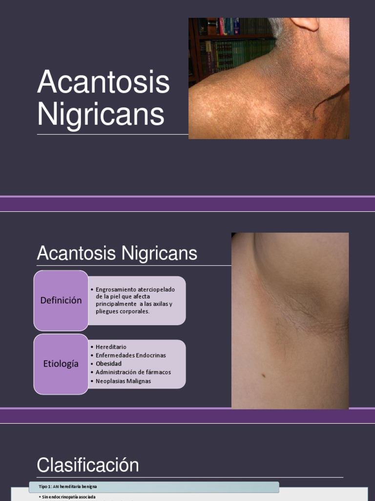 Acantosis Nigricans | PDF | Sistema endocrino | Medicina CLINICA