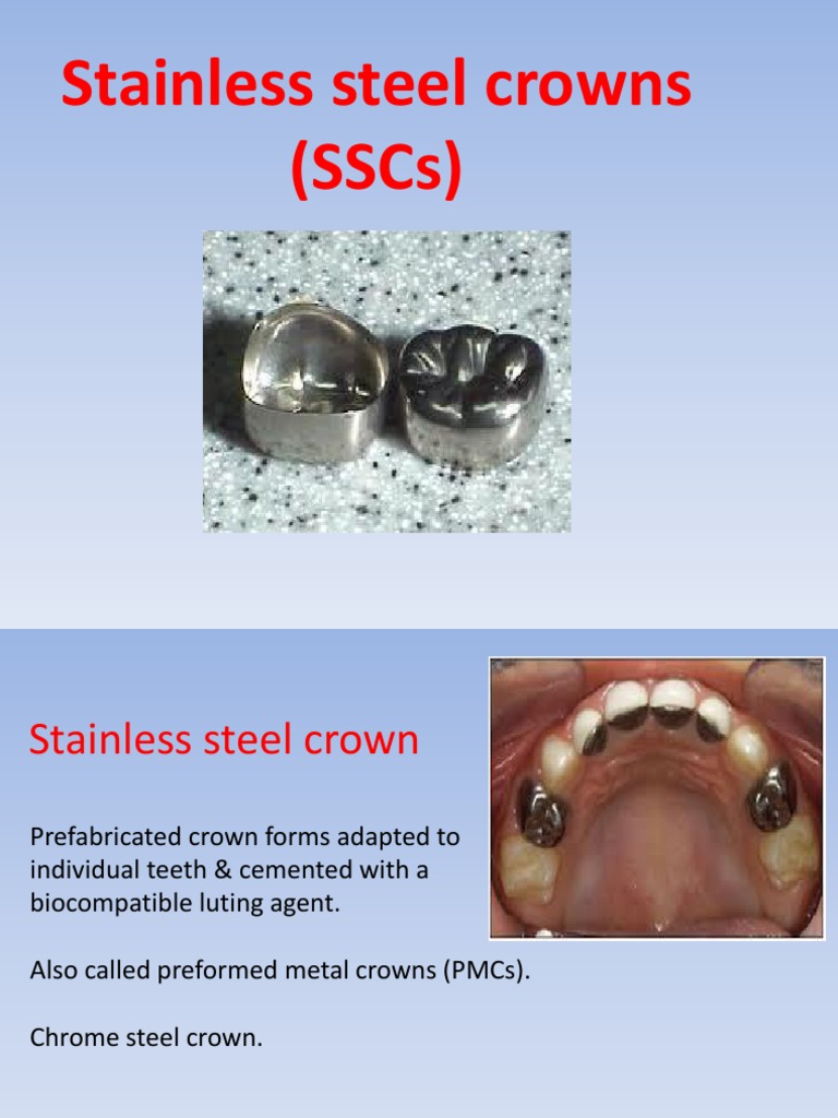 Stainless Steel Crowns (SSCS) PDF Dentistry Branches Mouth