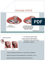 Estenosismitral 120925182633 Phpapp02