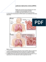 Enfermedad Pulmonar Obstructiva Crónica