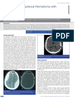 Bilateral Epidural Hematoma - Surgical Technique neurosurgery