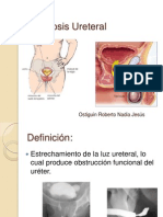 Estenosis Ureteral