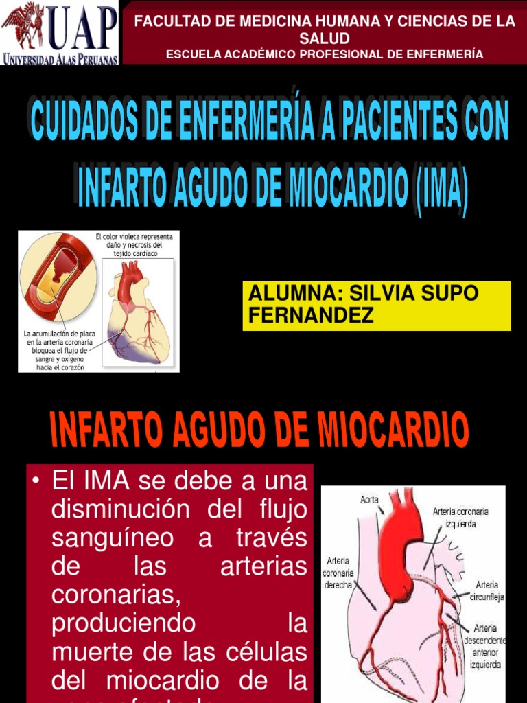 Ima PPT 2 | PDF | Infarto de miocardio | Corazón