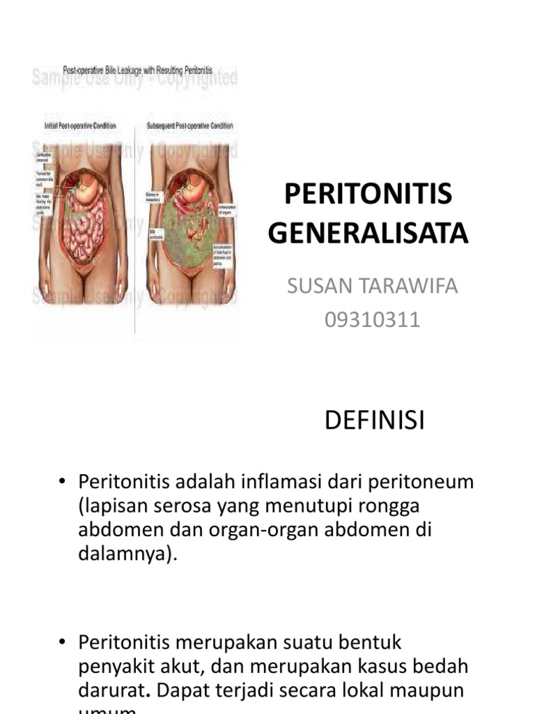 Peritonitis Generalisata | PDF