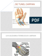 Sindromul de Tunel Carpian Oli