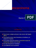 Ramon. Hepatocarcinoma