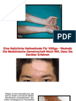 Vitiligo Heilbar, Vitiligo Schüssler Salze, Vitiligo Im Gesicht, Vitiligo Heilung Möglich