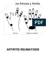 Diferencia entre artrosis y artritis: síntomas y manifestaciones