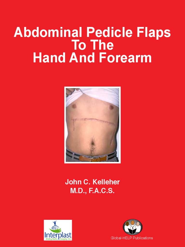 Abdominal Pedicle Flaps To The Hand and Forearm: John C. Kelleher M.D ...
