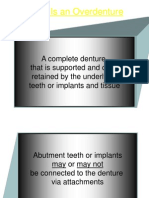 What is an Overdenture: Guide to Attachments & Benefits