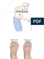 KYPHOSIS1