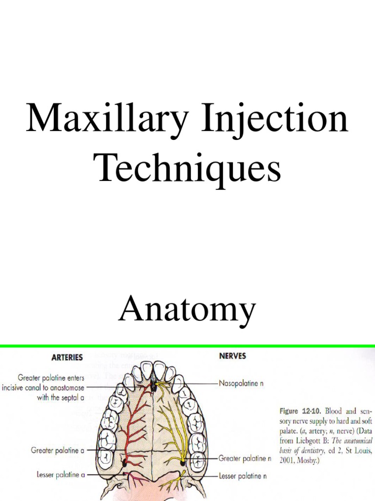 Maxillary Injection Techniques Anesthesia Injection (Medicine)