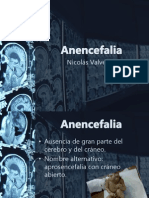 Anencefalia