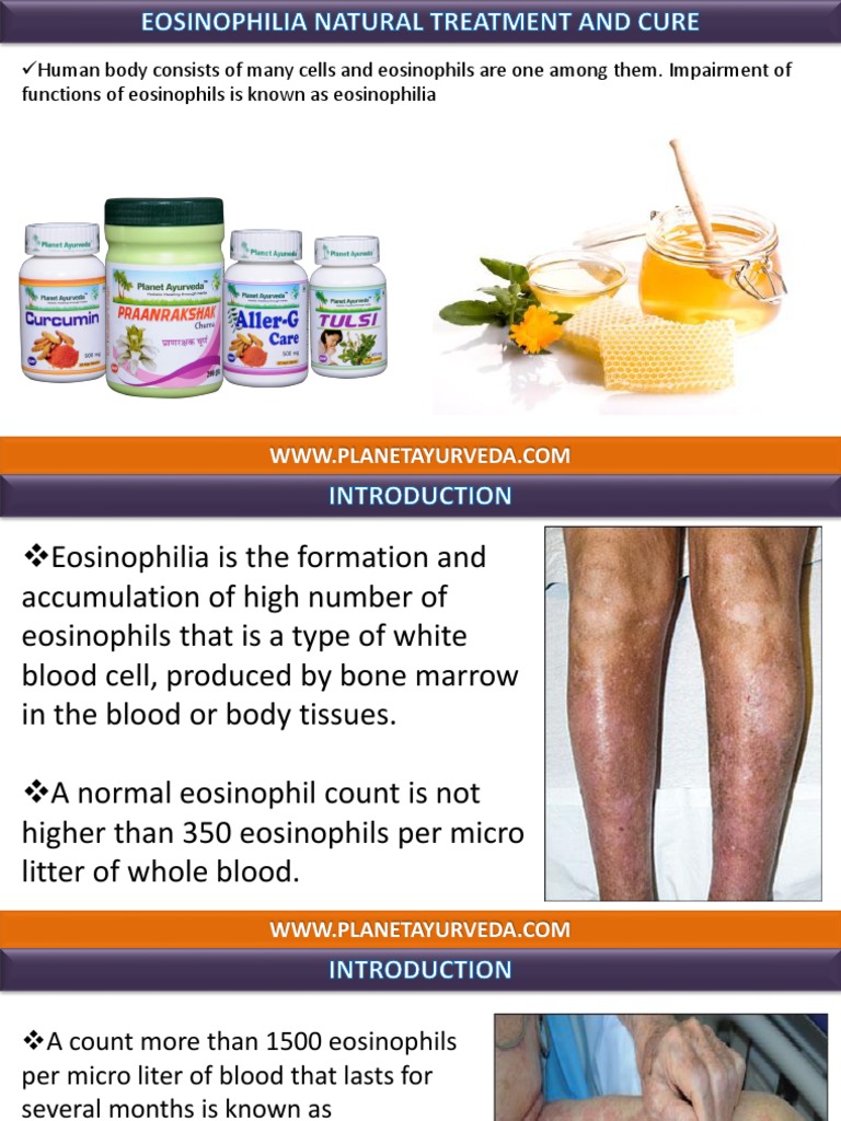 Natural Treatment For Eosinophilia & Cure PDF Allergy Clinical