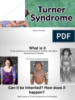 turner syndrome