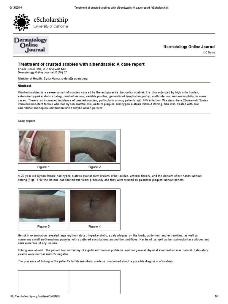 Treatment of Crusted Scabies With Albendazole - A Case Report ...