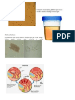 Hematuria Microscópica