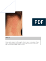 Figure 2-18: Lichen Simplex Chronicus Confluent, Papular, Follicular Eczema, Creating A Plaque of Lichen