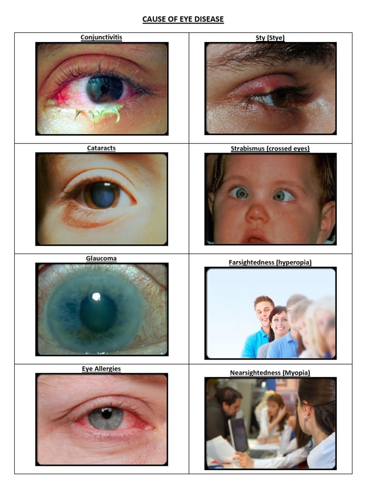 Cause of Eye Disease: Conjunctivitis Sty (Stye) | PDF