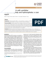 A Preterm Infant With Semilobar Holoprosencephaly and Hydrocephalus: A Case