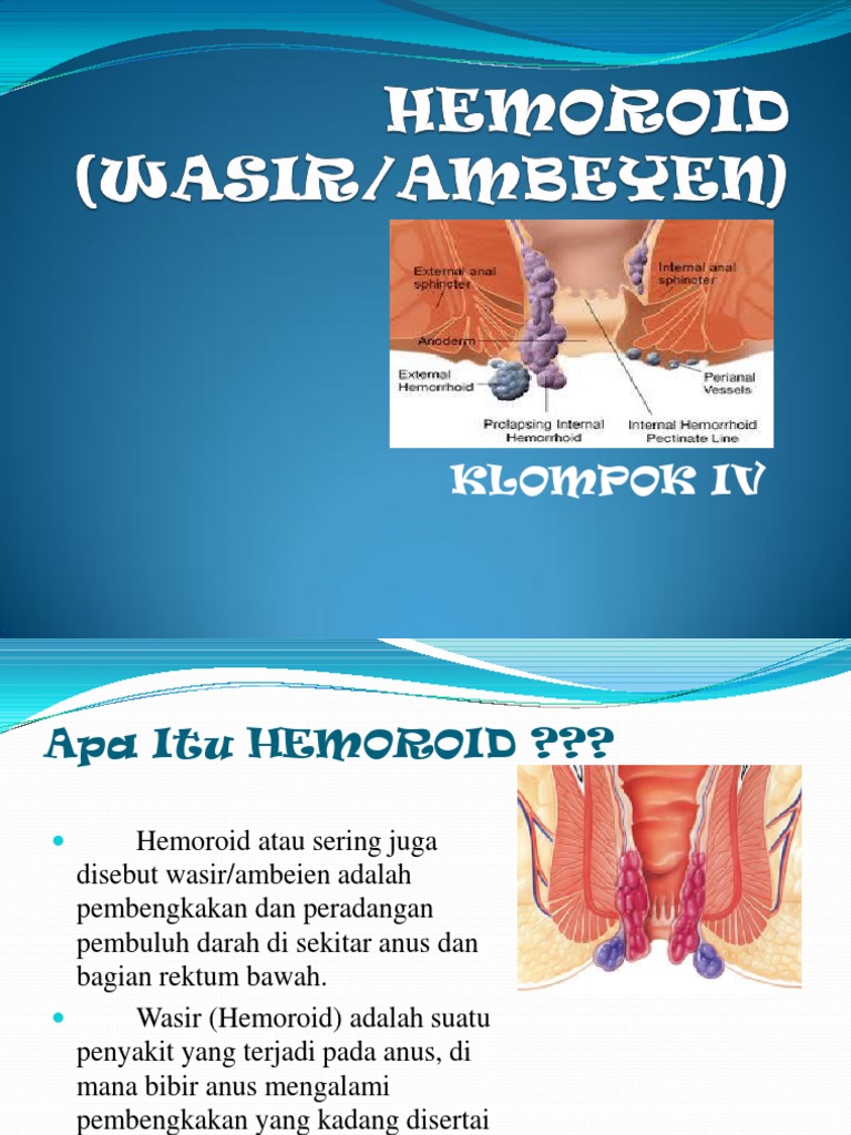 Understanding Hemorrhoids Causes, Symptoms, Complications and Treatment Methods PDF