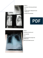 Gambaran Radiologi Spondilosis Thoracolumbal