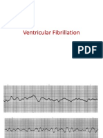 Ventricular Fibrillation