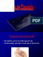 161247548 Fractura de Clavicula