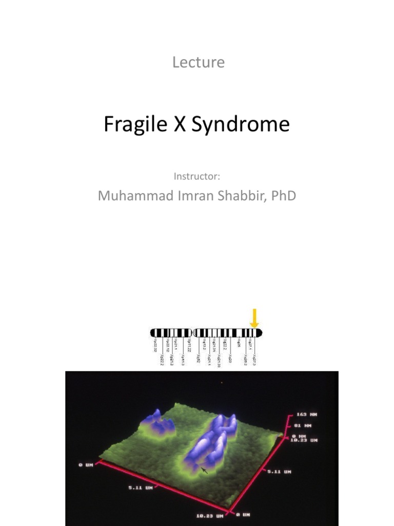 Understanding Fragile X Syndrome | PDF | Gene | Mutation