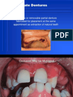 Immediate Denture