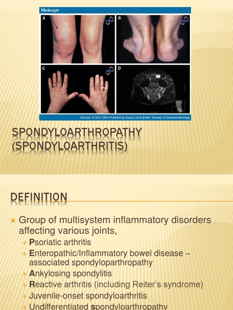 Spondyloarthropathy (Spondyloarthritis)