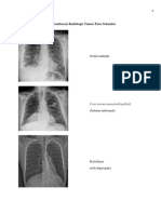 Gambaran Radiologis Tumor Paru Sekunder