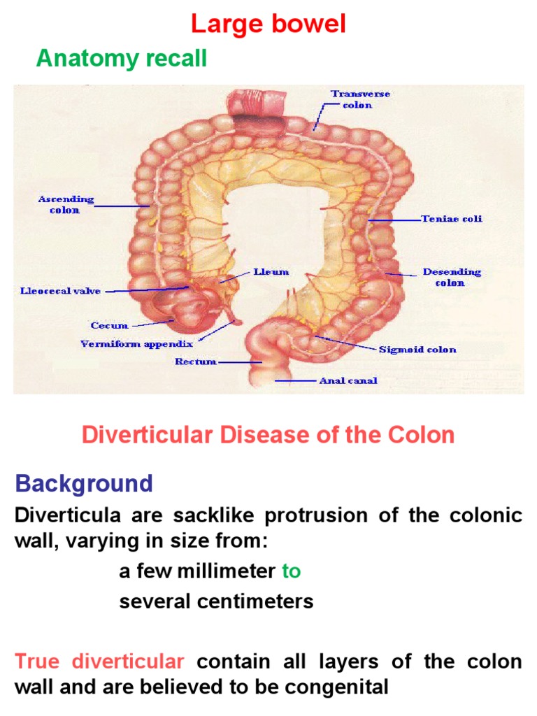 Understanding Diverticular Disease | PDF | Bleeding | Large Intestine
