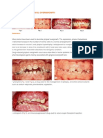 Drug Induced Gingival Overgrowth