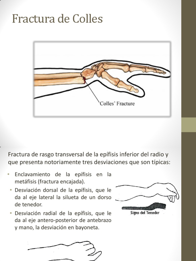 Fractura de Colles Smith Fmarginales Mano