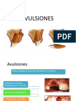 Avulsion Es