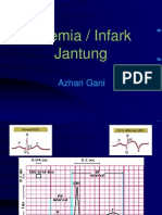 Infark Jantung