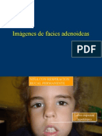 Facies Adenoideas