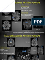 Malformaciones Arterio-Venosas